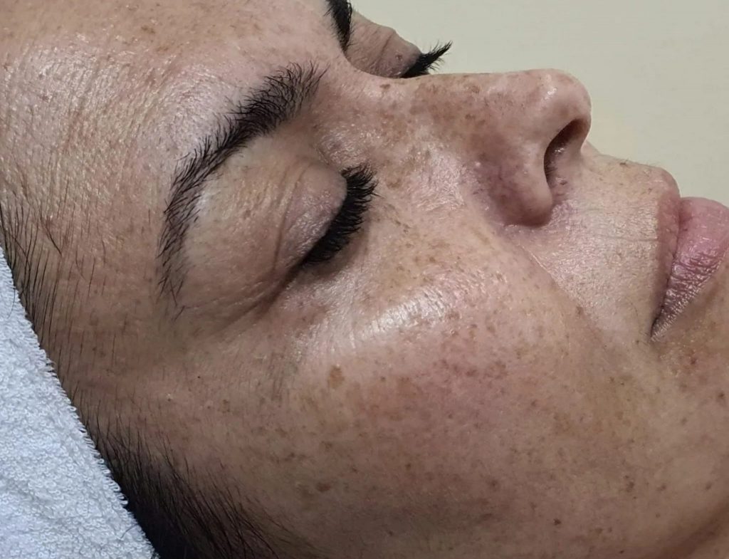 Chemical Peel: Tratamiento despigmentante,antes